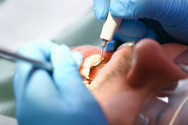 Best Emergency Gum Treatment in Compton, CA
